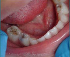 Cours sur Blake: l'emplacement des cavités, la classification et le traitement des caries dentaires