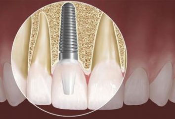 Quanto è quello di inserire i denti? Impianti dentali – un modo alternativo per tornare al suo antico sorriso bellezza