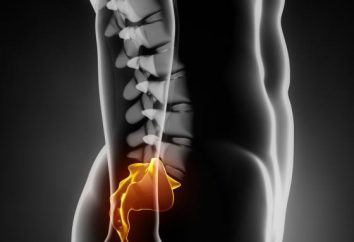 quiste perineural en el nivel de la s2 vertebral: cómo tratar?
