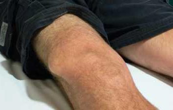 Luxation de l'articulation du genou: les principaux symptômes, traitement