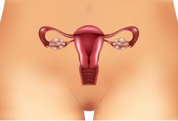 Die wichtigsten Symptome der polyzystischen Ovarien