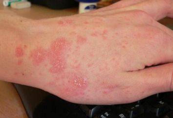 Le cause di allergia al sole ed i suoi metodi di trattamento