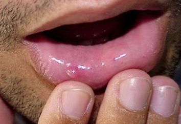 Ritenzione cisti del labbro inferiore: cause, il trattamento
