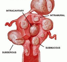 Come trattare i fibromi uterini senza intervento chirurgico: metodi, recensioni