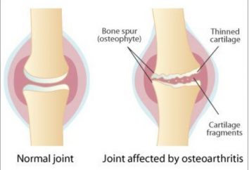 L'alimentation à l'arthrose du genou: Recommandations