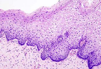 Qual è dekubitalnaya ulcera sulla cervice?