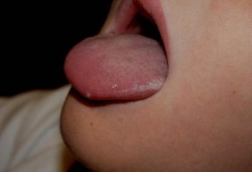 Il raid sulla lingua: come sbarazzarsi? Come rimuovere la placca dalla lingua?