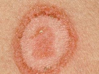 malattie fungine della pelle è più facile prevenire che curare