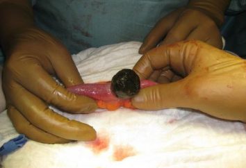 Causas, síntomas, tratamiento y eliminación de piedras de la vesícula biliar