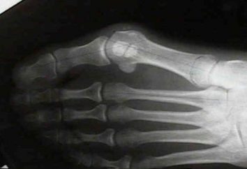 Bone en la pierna. férula ortopédica "Hallyufiks" para el tratamiento de los huesos: una revisión