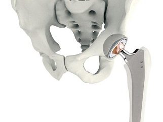 A articulação do quadril: substituição da anca, e ainda mais a recuperação