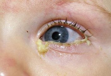 Purulenta occhi di un neonato – motivo di allarme?