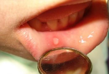 Zapalenie jamy ustnej u dzieci. Objawy choroby