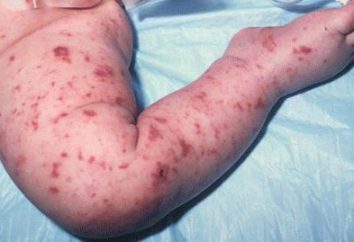 Os sintomas da meningite purulenta: que deve levar consultar imediatamente o médico