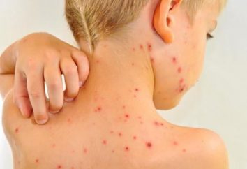 Quanto é mantido a uma temperatura de varicela? Como é a doença em crianças e adultos?