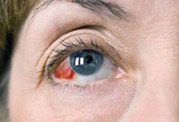 Perché scoppiare i vasi sanguigni negli occhi: cause e trattamento