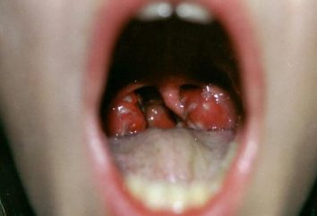 escarlatina – uma doença infecciosa que se manifesta rash