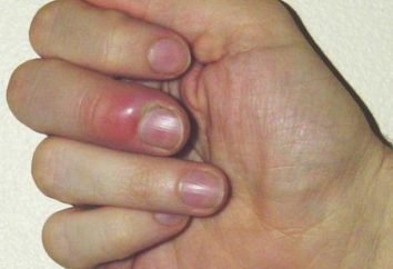 Co można zrobić, jeśli uruchomić się palcem w pobliżu paznokci