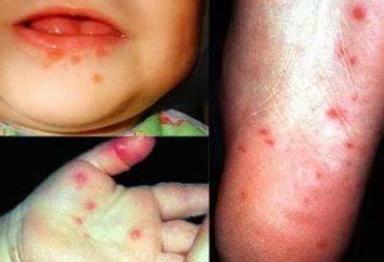 infection entérovirus chez un enfant: traitement, symptômes, prévention