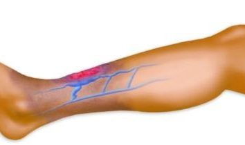 caillot de sang dans une veine de la jambe: le traitement des remèdes populaires