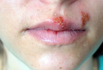 Comme en témoignent les bulles sur la peau? Description et traitement des maladies les plus courantes
