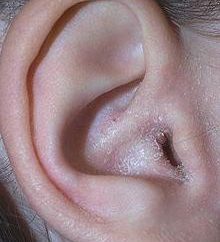 Nieżytowe zapalenie ucha środkowego: Objawy, diagnostyka i leczenie