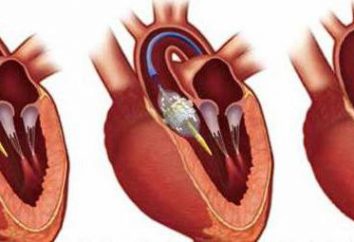 Zastawki serca: Operacja zastąpienia i ewentualne choroby