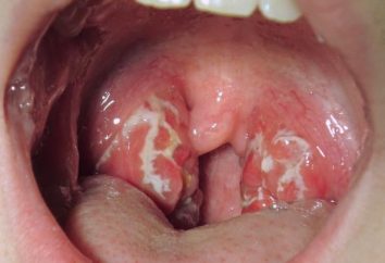 Lacunar Tonsillitis bei Kindern. Symptome, Behandlung, Foto lacunar Tonsillitis bei Kindern