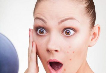 Teenage acne nelle ragazze: il trattamento, le cause