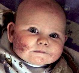 Co to jest atopowe zapalenie skóry u niemowląt?