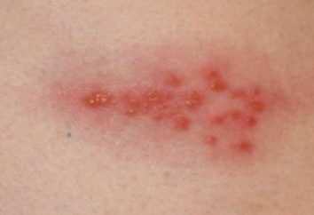 L'herpes zoster – contagiose o no? Herpes zoster: Cause