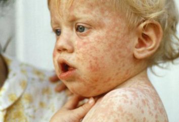 épidémie de rougeole: l'urgence, le danger, la protection