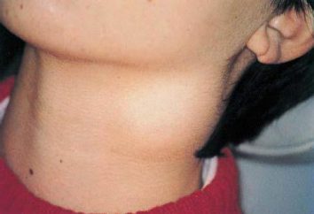 pescoço mediana cisto e lado: o tratamento. O cisto é perigoso?