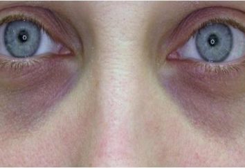 Wie dunkle Ringe unter den Augen entfernen? Lernen effektive Methoden