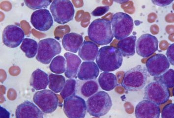 Acuta di sangue Leucemia: quanti vivono, caratteristiche di trattamento e la diagnosi