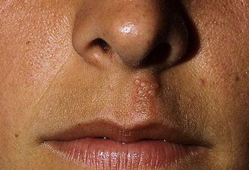 En la nariz, el herpes labial: Cómo recuperar tan pronto como sea posible?