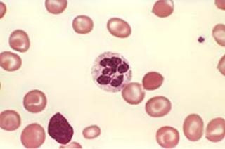 Co to jest anemia 1 stopień w czasie ciąży: przyczyny, objawy i leczenie