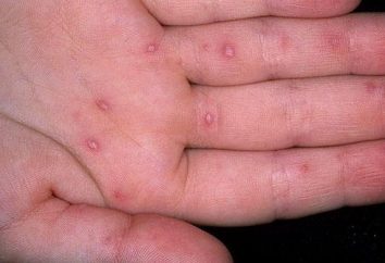 burbujas de agua en las manos – el sarampión, la sarna o …