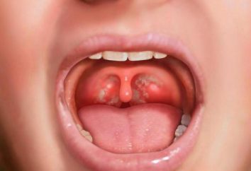 Nas tonsilas pontos brancos: o que fazer? Como tratar as amígdalas?