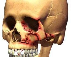 Złamania czaszki: rodzaje, objawy, leczenie i konsekwencje