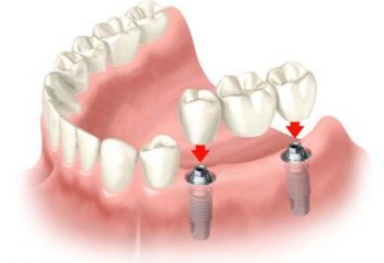 Quanto é a implantação de um único dente em hospitais modernos
