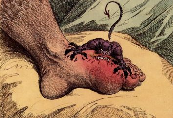 Gout in den Füßen: das Alter der Krankheit oder Exzesse?