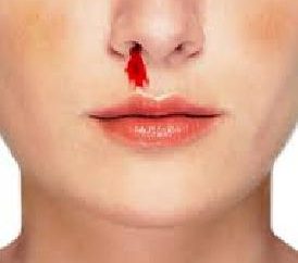 Jak powstrzymać krwotoku z nosa. Dlaczego krew z nosa jest w godzinach porannych. Często zdarza się, krwawienie z nosa