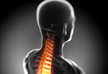 Stenosi del canale spinale cervicale: cause, sintomi, diagnosi e trattamento