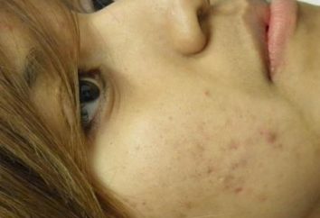 Come sbarazzarsi di cicatrici da acne?