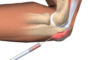 La bursitis de la articulación del codo: tratamiento, los síntomas y las causas de