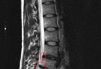 Retrolistesis vértebra L5 – ¿qué es? enfermedades de la columna vertebral con el desplazamiento vértebras