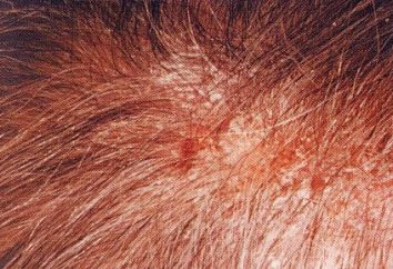 Seborrhoische Dermatitis auf dem Kopf: die Behandlung und klinisches Bild