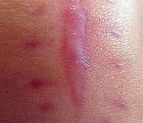 Koloidalne blizny – wady skóry lub zaburzenie genetyczne?