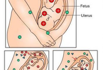 madre Rh-conflitto e feto durante la gravidanza: un tavolo. conflitti immunitario della madre e del feto